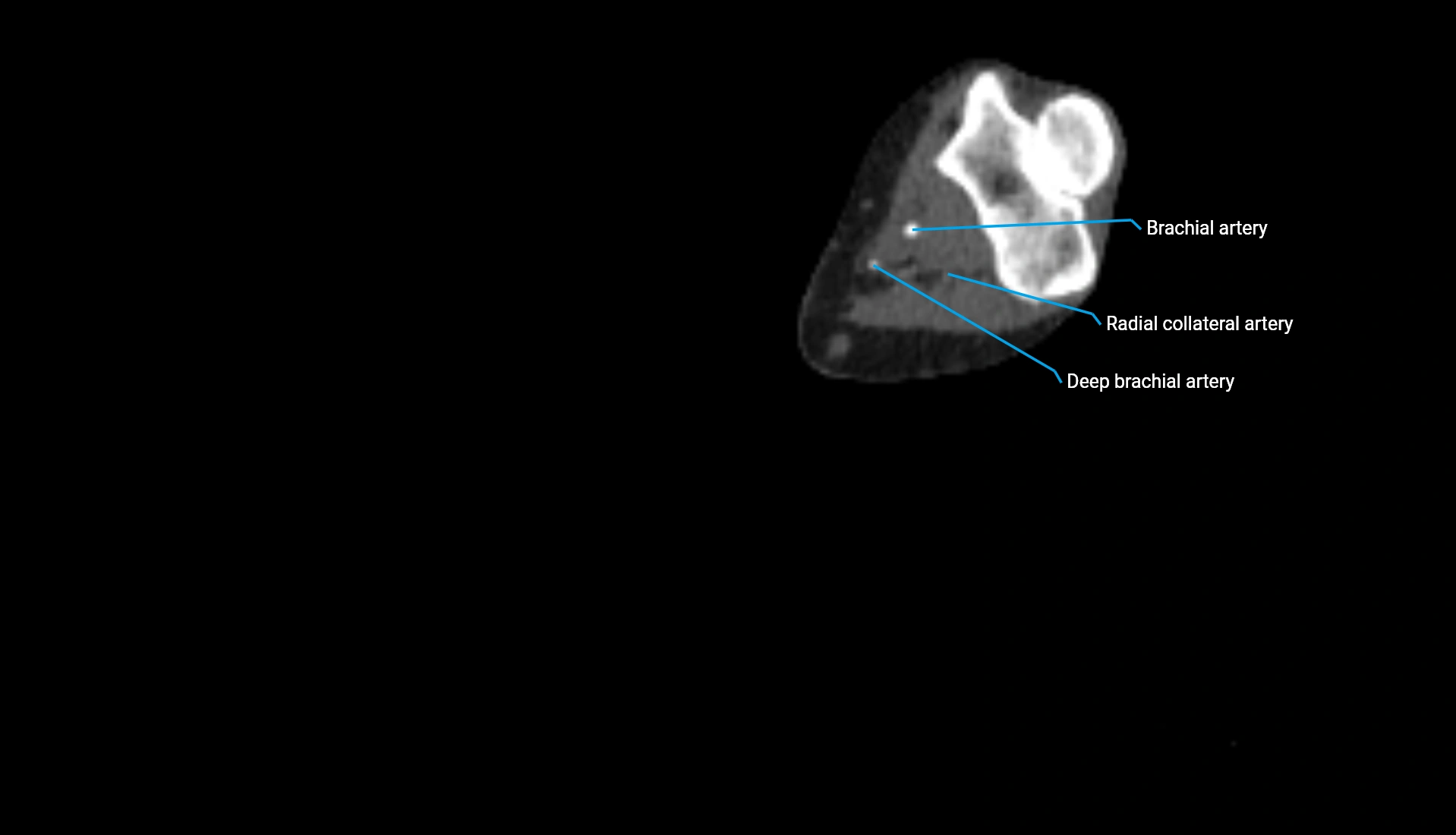 CTA upper limb axial cross sectional anatomy labelled image 190 (2).webp